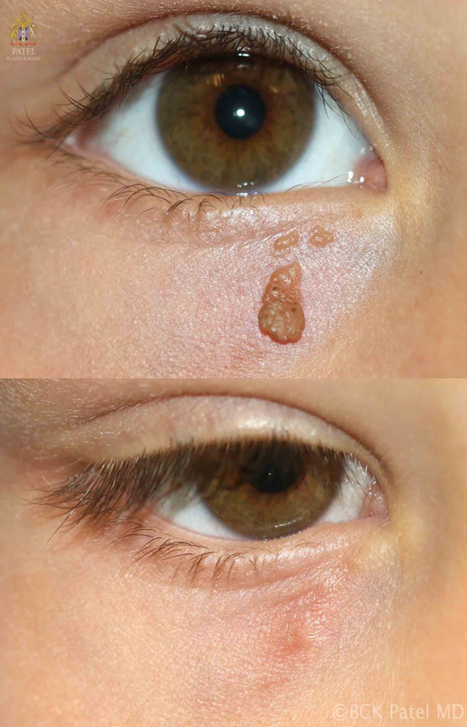 Laser removal of pigmented raised moles on the lower eyelid by Dr. BCK Patel MD, FRCS