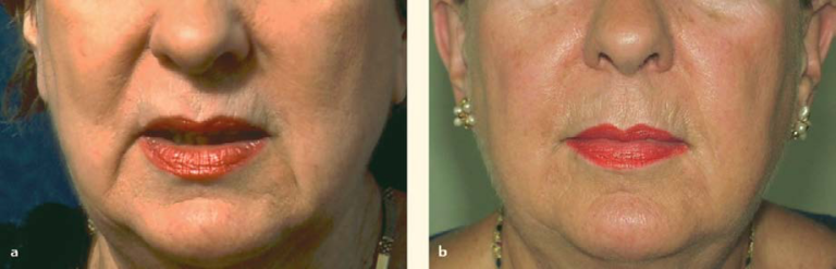 improvement in the melolabial folds and the angle of the mouth using the lifting surgical technique together with surgical weakening of the depressor angulari soris and fat augmentation of the mesolabial folds.