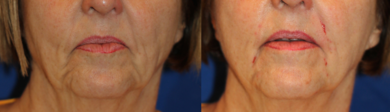 Improvement immediately after using fillers in the melolabial folds and in the pre-jowl sulcus.