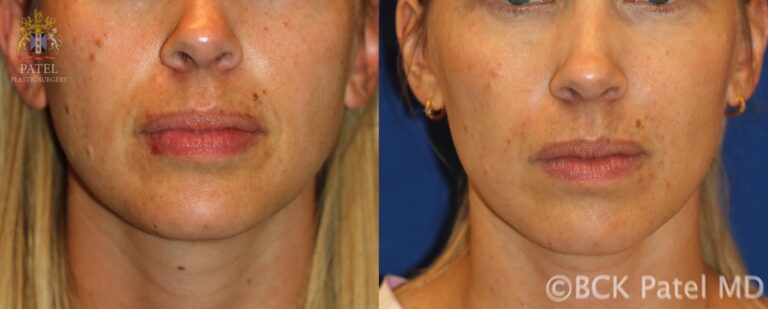 Removal of select moles that bother the patient with lasers and other tools yields very nice results