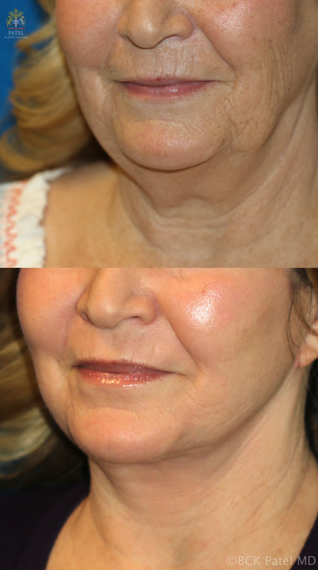 All of the aging changes that affect the perioral region are addressed in the above patient with improvement in the nasolabial folds, the melolabial folds, the pores, the vertical lip lines, the loss of lip volume, the jawline, the jowls and the pre-jowl sulcus.