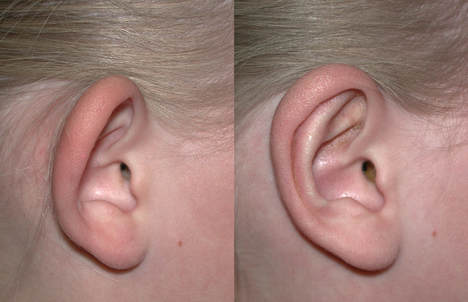 otoplasty-3