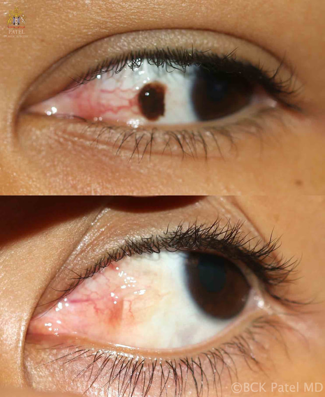 Pigmented lesions on the body or the eyeball should be treated with great attention to the proper diagnosis. Removal and repair will yield nice results. Tumor resection and repair with cosmetic results in mind by Dr. BCK Patel MD, FRCS