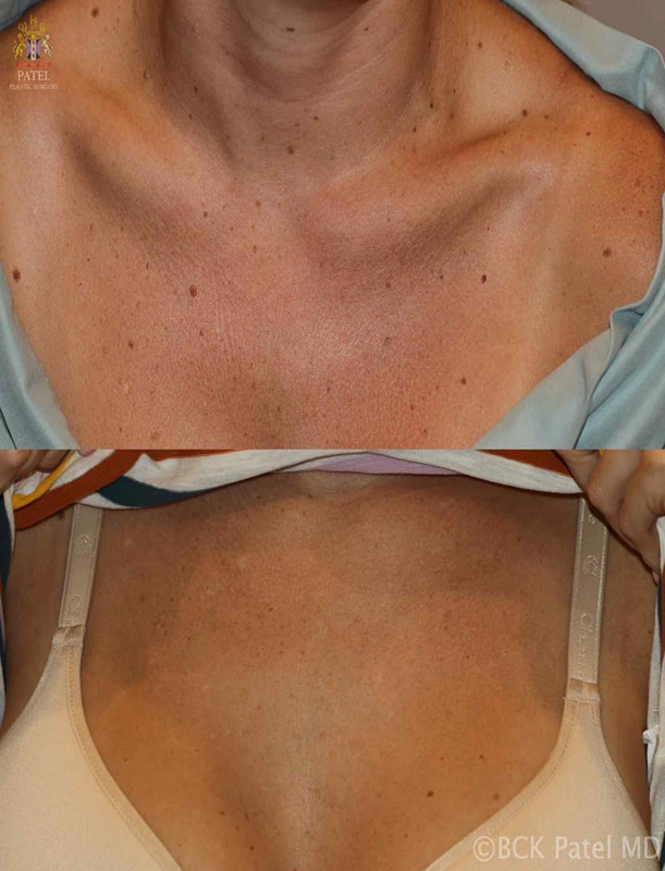 Removal of multiple raised as well as flat mols using a combination of techniques including lasers, surgery and suturing by Dr. BCK Patel MD, FRCS