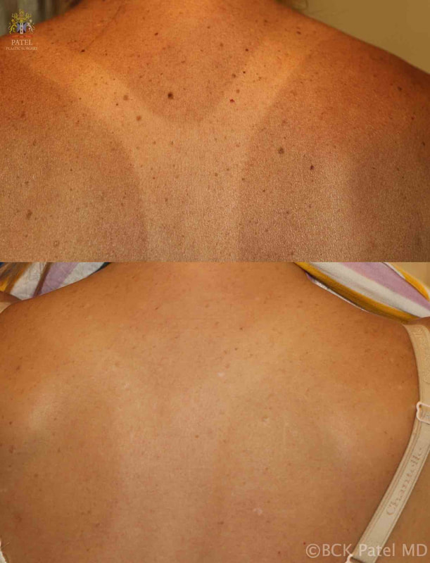 Raised and flat moles are common on the back. Here, the lesions were removed and reduced in size in preparation for an upcoming wedding by Dr. BCK Patel MD, FRCS