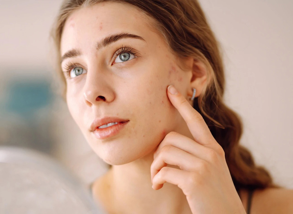Young woman with problem skin looking into mirror