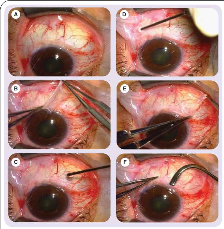 Sequence showing the use of the amniotic membrane in extensive conjunctival reconstruction