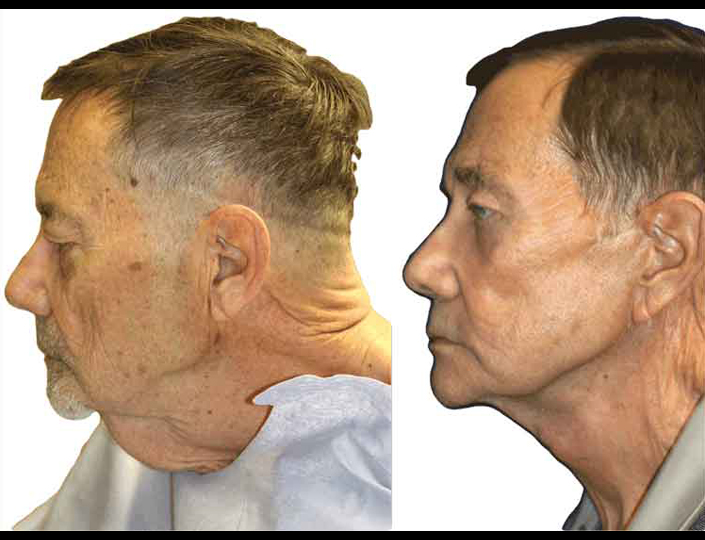 13-face-and-necklift-male_1_orig