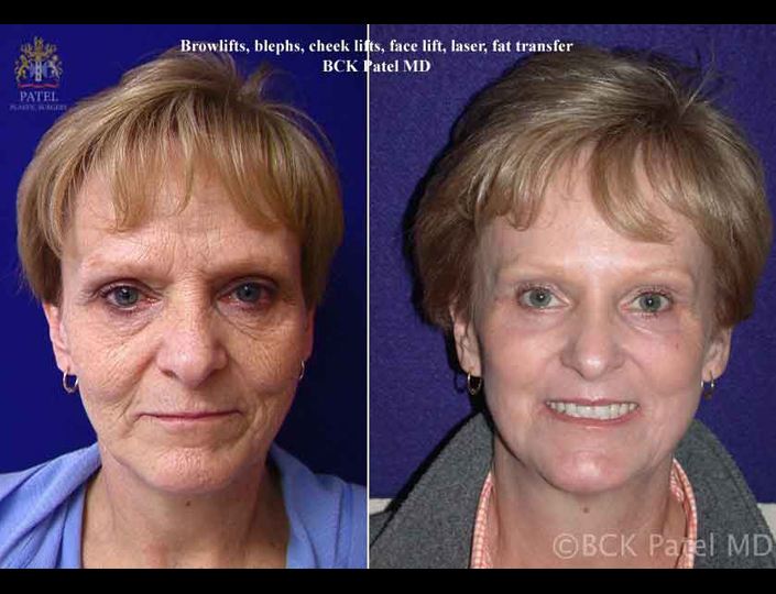 before-and-after-laser-facelift-blephs_1_orig