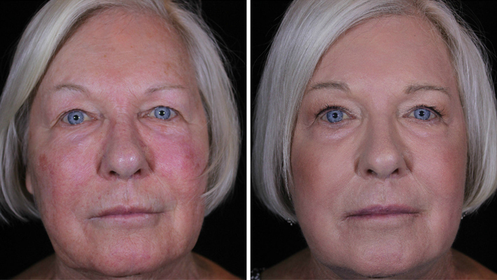 betsy-after-j-plasma-april-2017