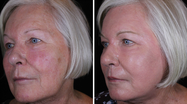 betsy-after-side-2-april-2017