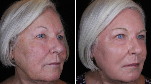 betsy-j-plasma-after-side