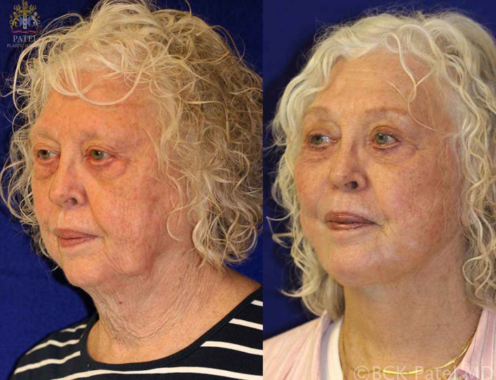 carter-janet-pre-post-2_orig