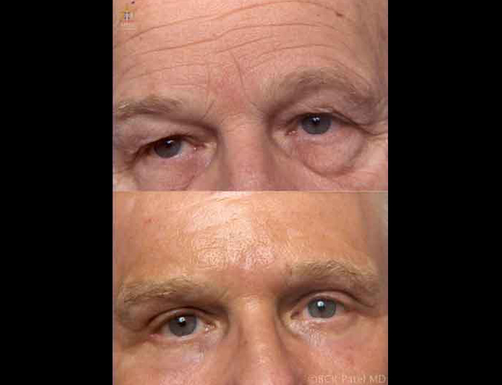 cropper-pre-post-lowers_orig