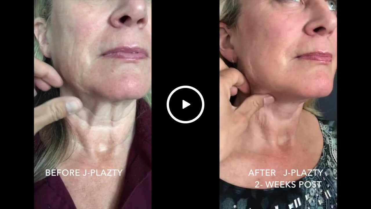 Before and after comparison showing neck laxity improvement in a woman two weeks post J-Plazty treatment, centered on a video thumbnail.