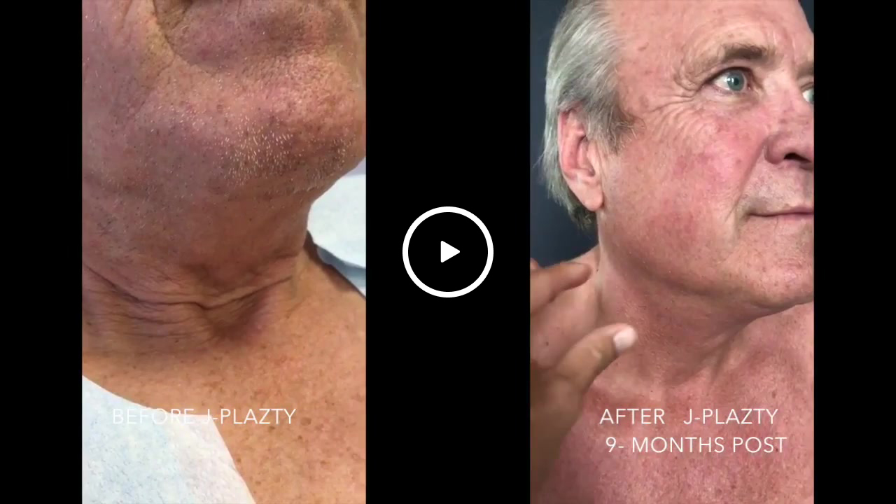 Before and after comparison showing reduced neck wrinkles and skin laxity on an older man following J-Plazty treatment.