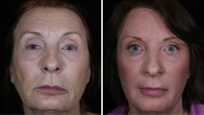 leslee-after-april-2017