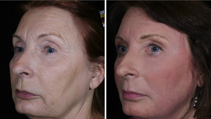 leslee-april-2017-side-2