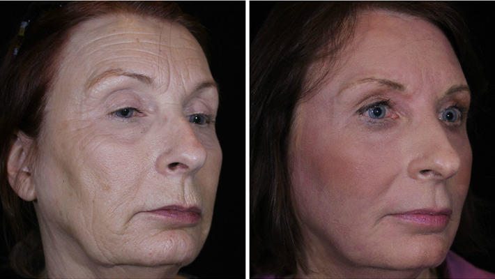 leslee-side-april-2017