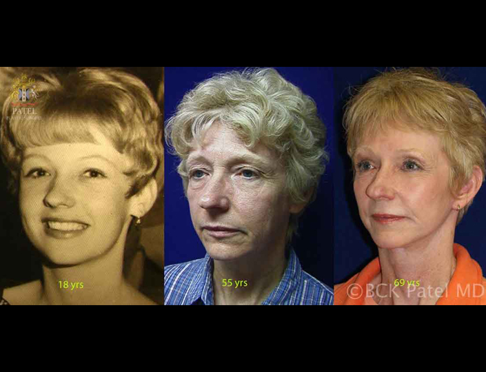 lipparelli-kerry-pre-post-face-hammock-long-yrs-copy_orig