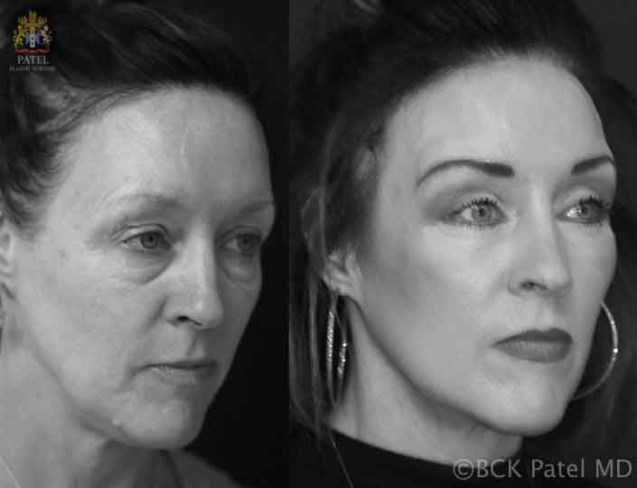 mcbride-melanie-pre-post-early-b-w_orig