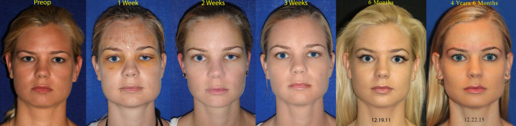 Out of State Patients Grow Lieren Longitudinal Study Brows