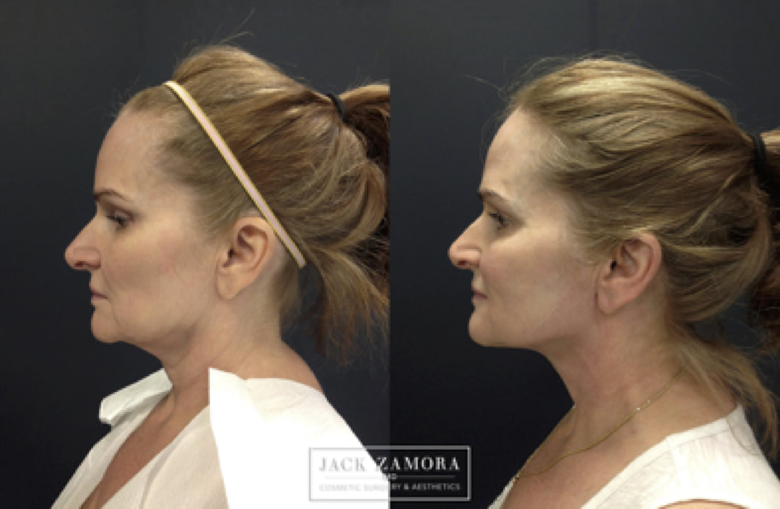 Split-view profile comparison showing a woman's neck and jawline before and after a cosmetic procedure.