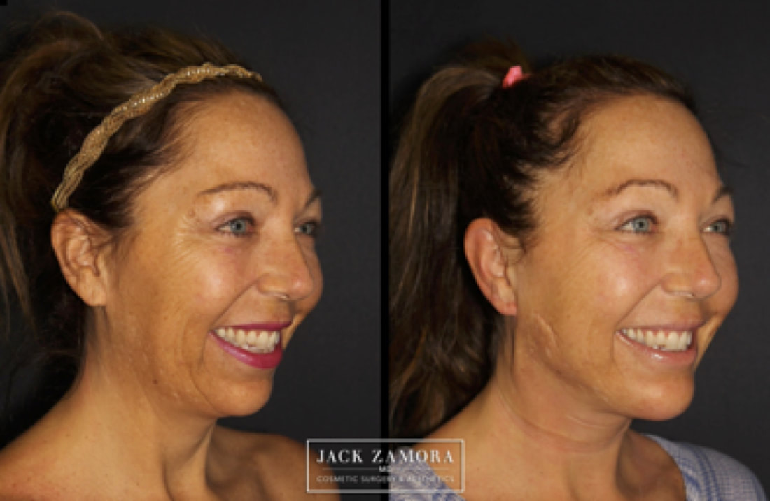 Before and after profile view of a smiling woman showing facelift results next to a logo for Jack Zamora MD Cosmetic Surgery & Aesthetics.