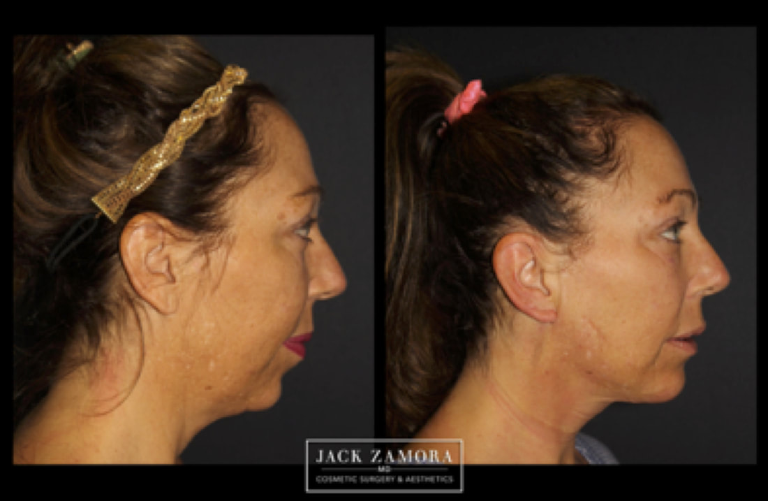 Side-by-side before and after profile comparison of a woman showing improvement in the jawline and neck area following a procedure by Jack Zamora MD Cosmetic Surgery & Aesthetics.