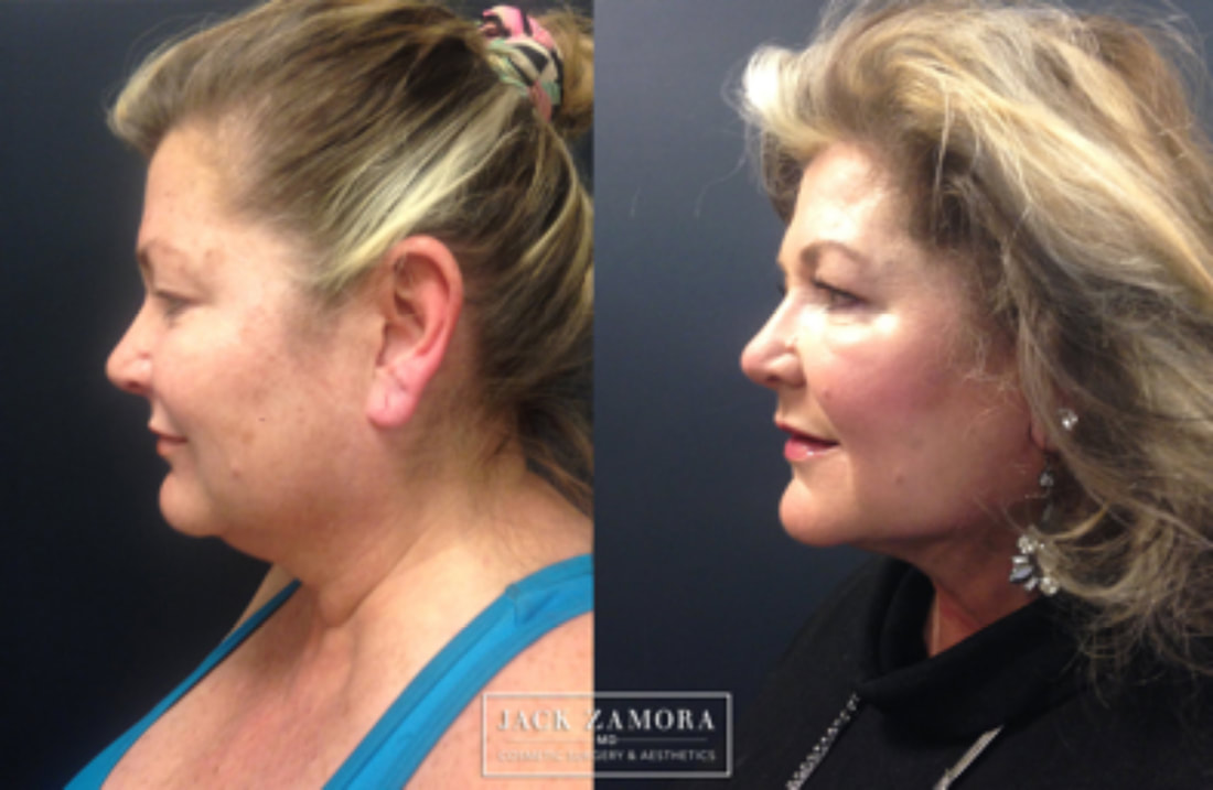 Before and after profile comparison of a woman showing significant improvement in submental fullness following a cosmetic procedure, featuring the "Jack Zamora MD" logo.
