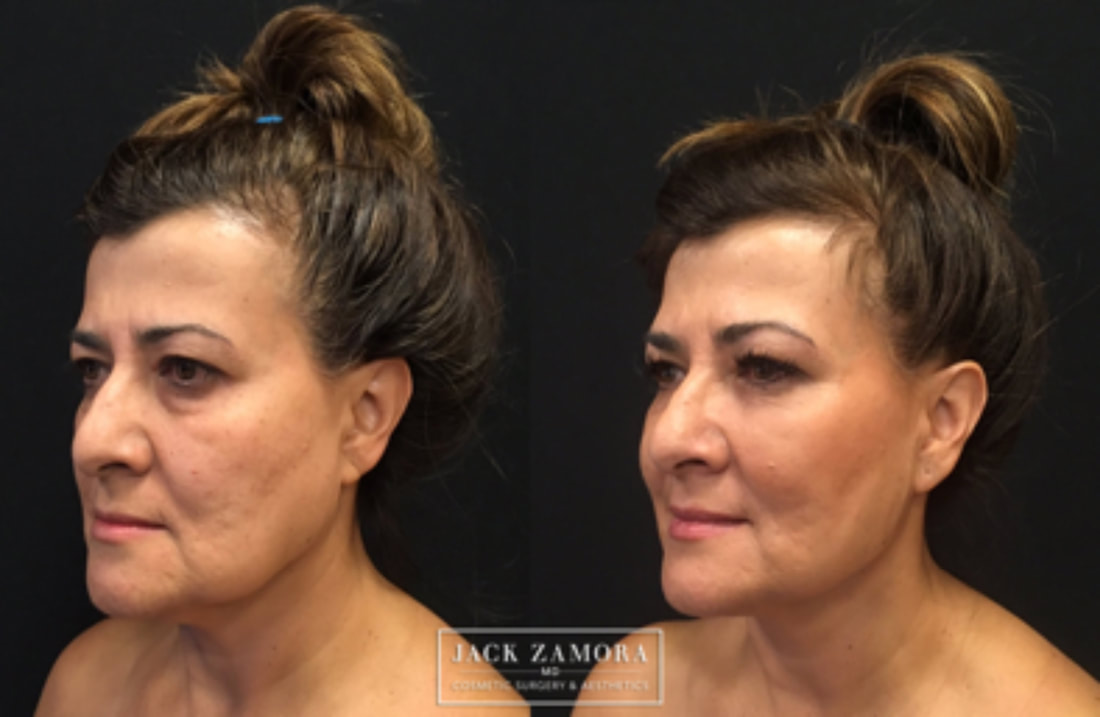 Before and after profile comparison of a woman showing facial rejuvenation results, with a logo for Jack Zamora MD Cosmetic Surgery & Aesthetics in the center.