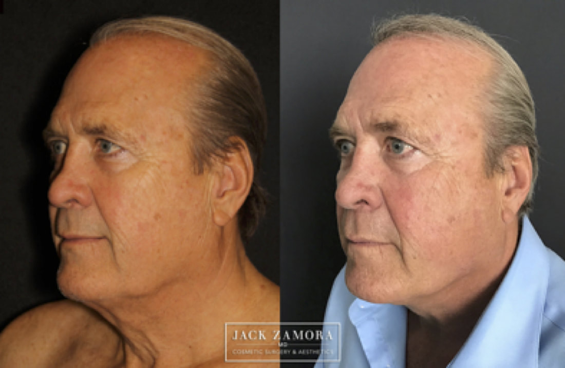 Before and after profile comparison showing an older man's facelift results, with the after image on the right showing a sharper jawline and reduced neck laxity.