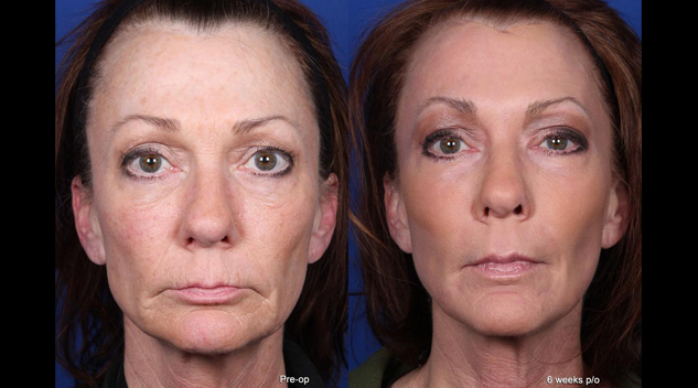 pre-and-6-weeks-front