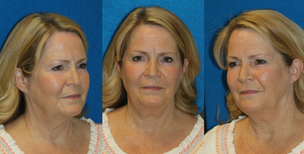 Out of State Patients Set 1