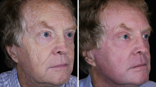 stan-after-8-weeks-right