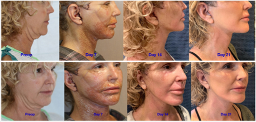 Healing after a deep plane facelift and neck lift, Day 7 to Day 21