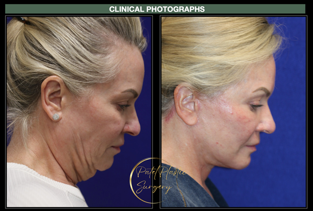 side profile view of woman before and after facelift and neck lift (first view)