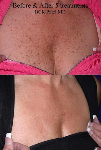 before and after 5 treatments to clear skin in upper chest and neck area