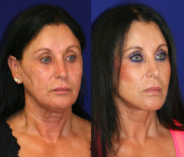 facelift and neck lift