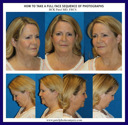 example of photograph sequence for preparing for facelift and neck lift
