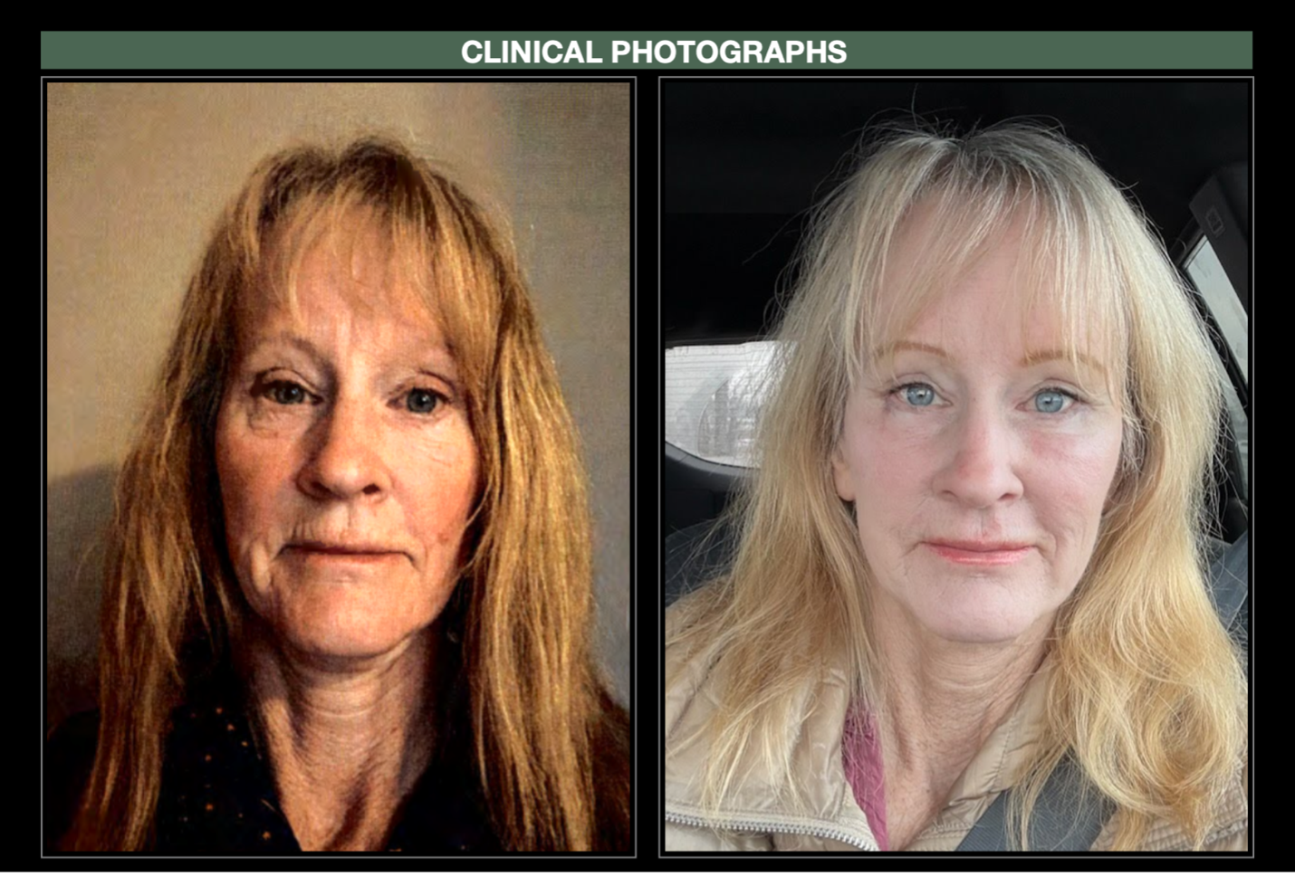 patient before and after full-face CO2 laser treatment and lower blepharoplasty