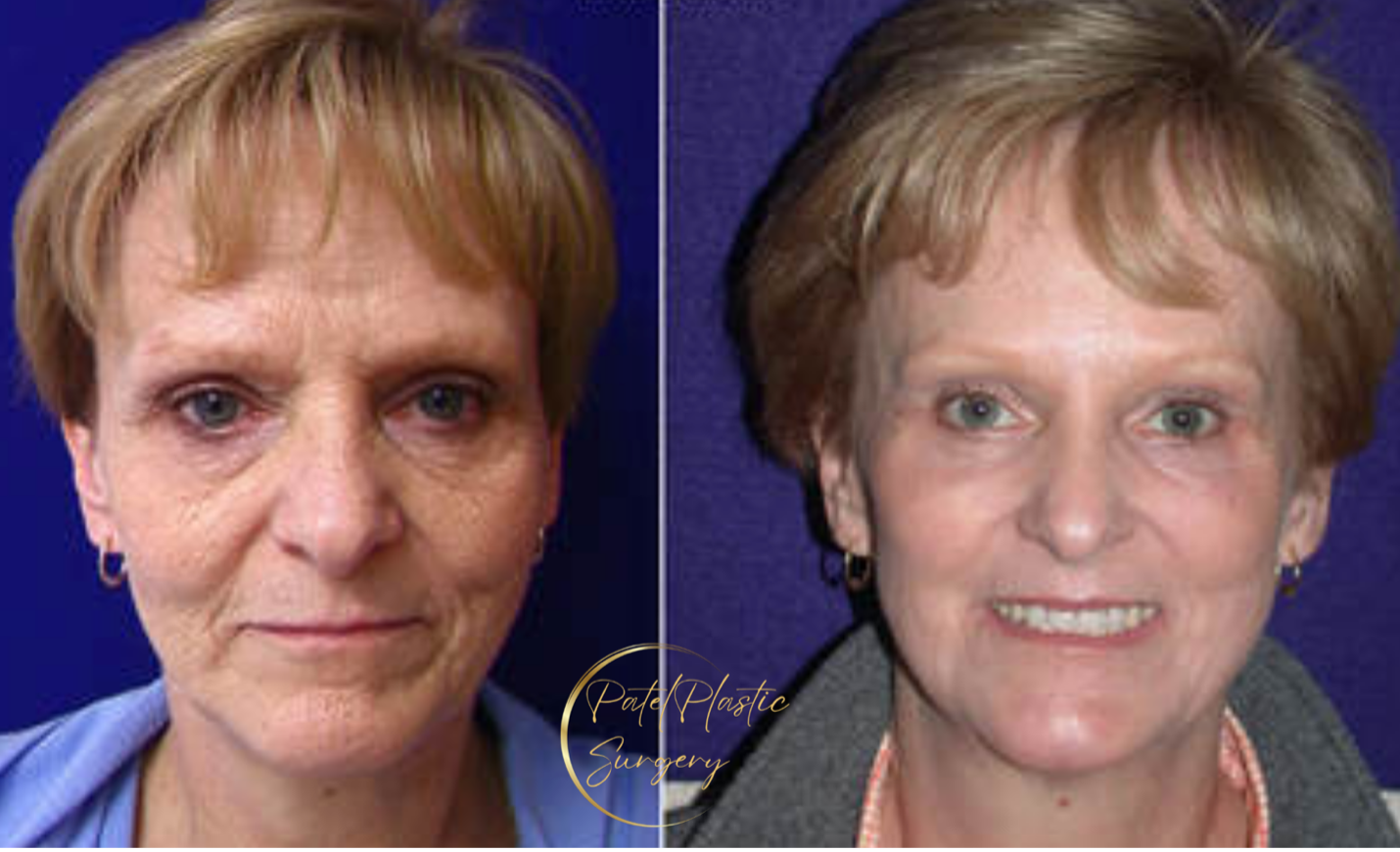 before-and-after photo for female patient after co2 laser and hammock lift