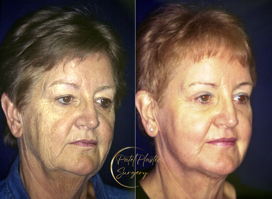 Before-and-after photos of patient following fractionated CO2 laser treatment and serum extract