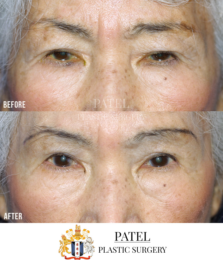 Eastern Eyelids Patient 10