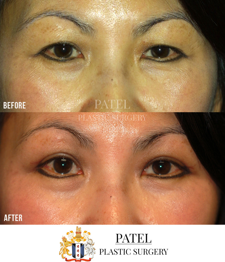 Eastern Eyelids Patient 11