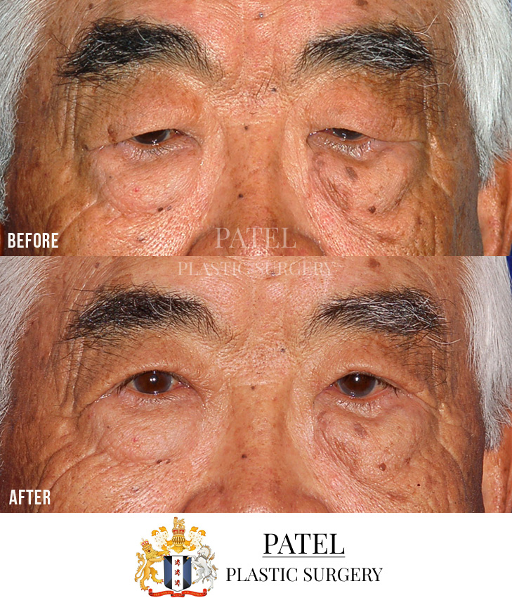 Eastern Eyelids Patient 12