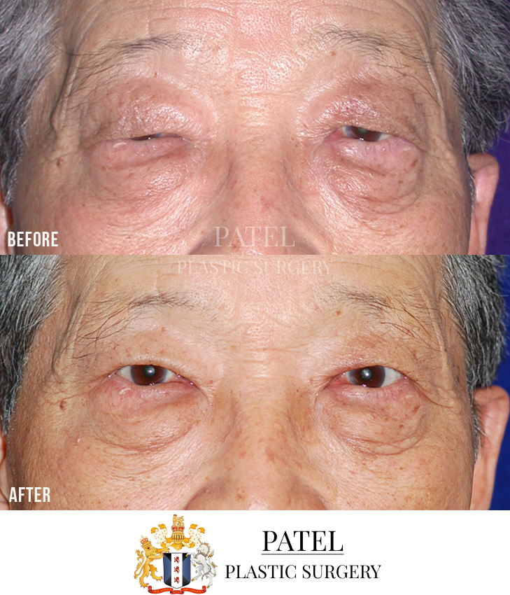 Eastern Eyelids Patient 13