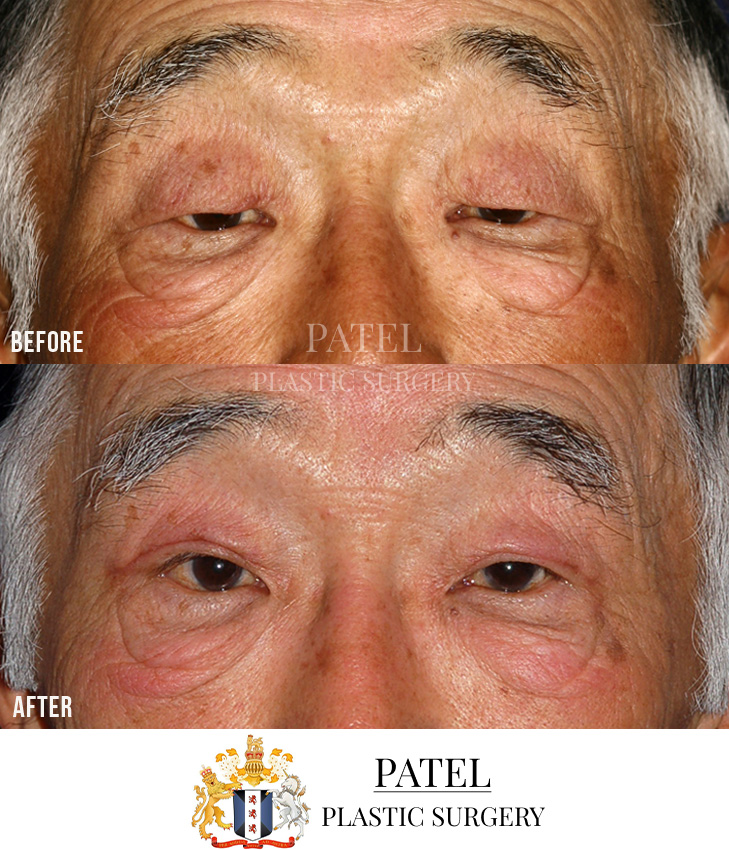 Eastern Eyelids Patient 14