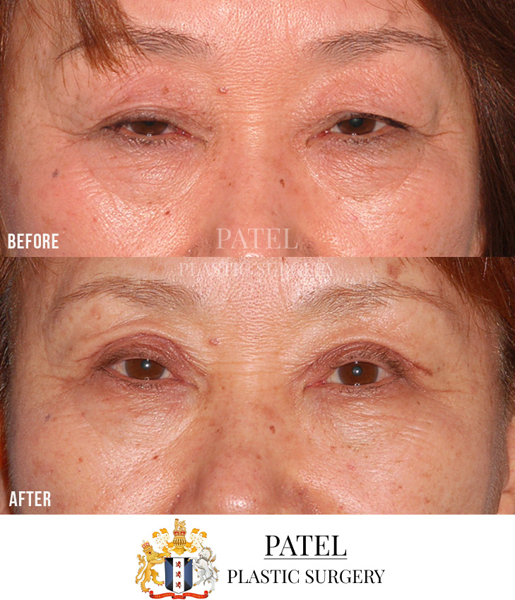 Eastern Eyelids Patient 15