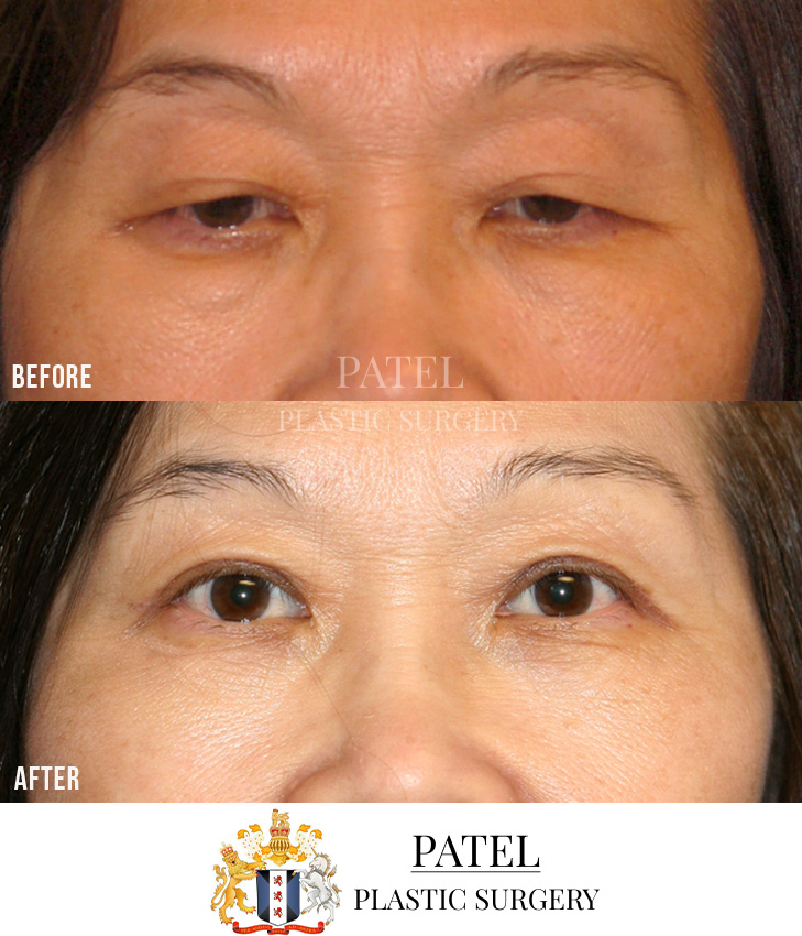 Eastern Eyelids Patient 16